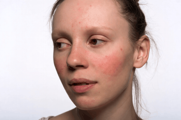 Купероз. Рекомендовані продукти Vivasan, Швейцарія. Натуральні товари компанії Vivasan, Швейцарія в категорії Купероз.